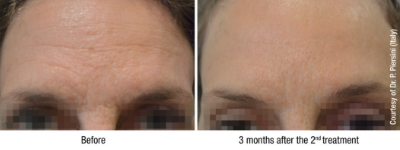 Viscoderm Before and After